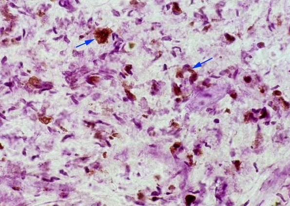 4E MLD (Case 4) Hirsch-Pfeiffer 1 copy