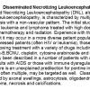 0A Necrotizing Leukoencephalopathy - Text