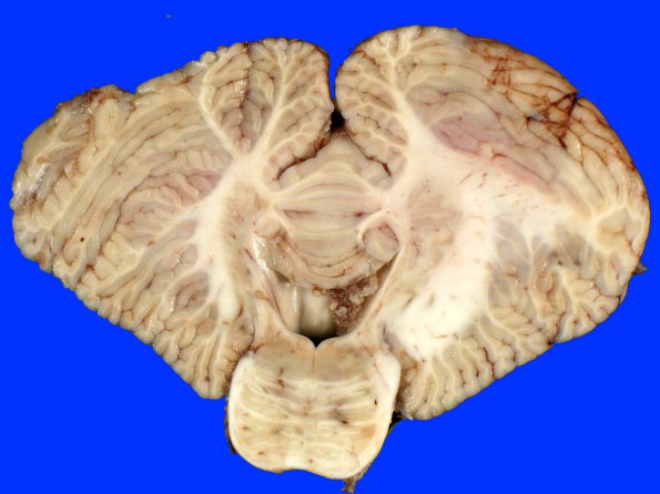 1A2 Radiation necrosis (A06-138) Gross _4