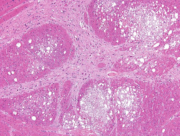 1B3A DNL (Case 1) H&E 3