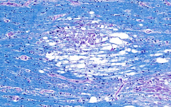 1B4B DNL (Case 1) LFB-PAS 20X