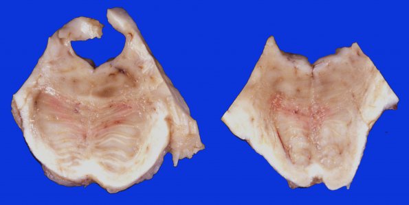 2A1 Necrotizing Leukoencephalopathy (Case 2) 3