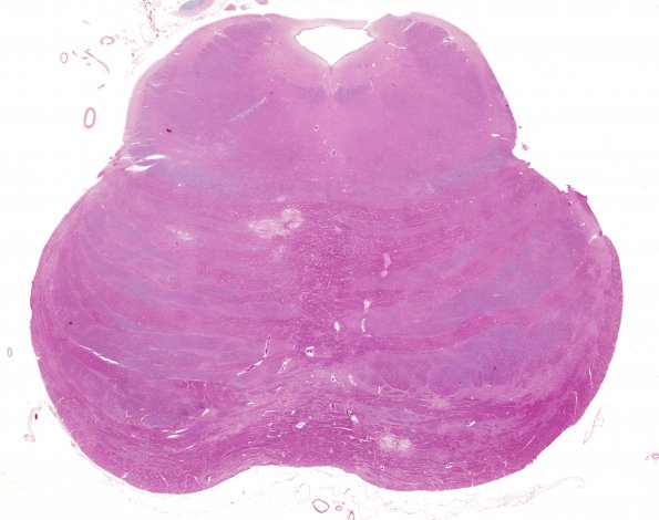 3B1 DNL (MTX & Rx Mantle Cell Lymphoma, Case 3) H&E whole mount 1