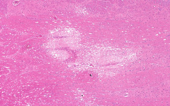 3B2 DNL (MTX & Rx Mantle Cell Lymphoma, Case 3) H&E 4X