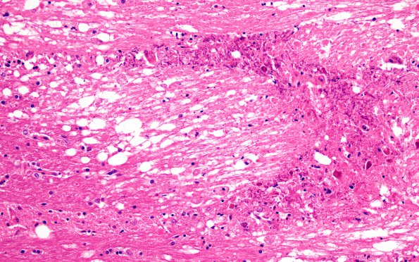 3B3 DNL (MTX & Rx Mantle Cell Lymphoma, Case 3) H&E 20X