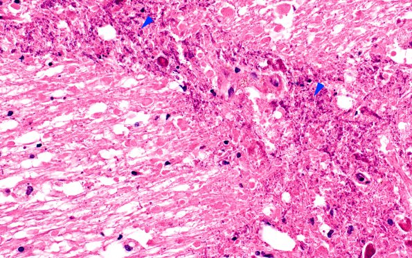 3B4 DNL (MTX & Rx Mantle Cell Lymphoma, Case 3) H&E 40X copy