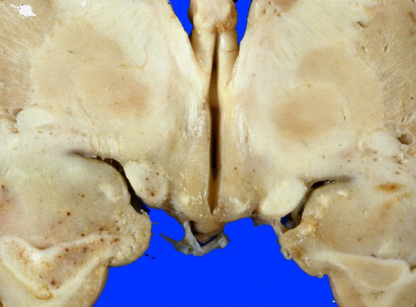 4A3 MTX & Radiation (Case 4) Gross 12