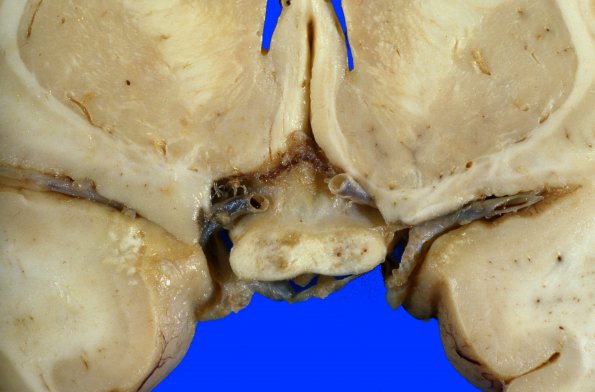 4A4 MTX & Radiation (Case 4) Gross 4