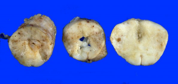 4A5 MTX & Radiation (Case 4) Gross 6