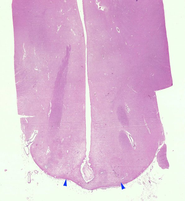 4B1 MTX & Radiation (Case 4) H&E WM copy