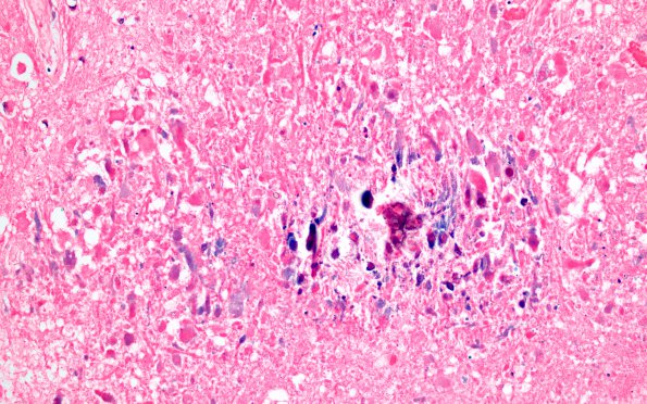 4B2 MTX & Radiation (Case 4) WM 2