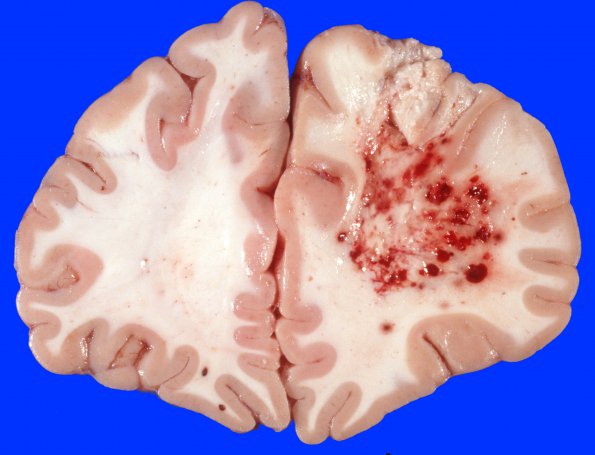 5A1 DNL (Case 5) ALL Rx, MTX local to WM & RAD gross 8