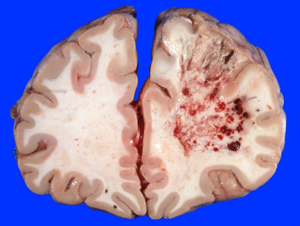 5A2 DNL (Case 5) ALL Rx, MTX local to WM & RAD gross 5