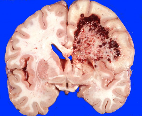 5A4 DNL (Case 5) ALL Rx, MTX local to WM & RAD gross 4