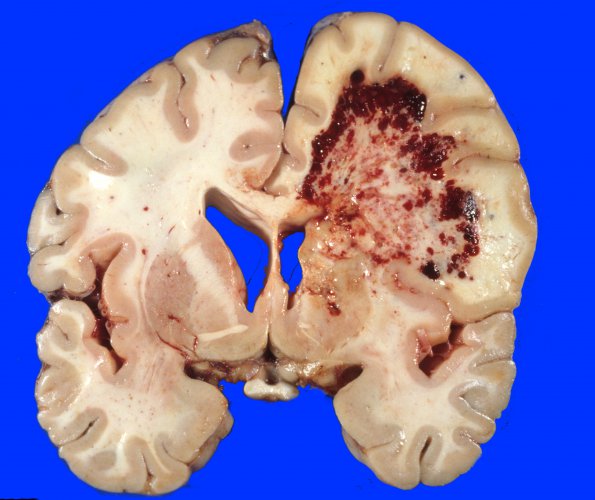 5A6 DNL (Case 5) ALL Rx, MTX local to WM & RAD gross 1