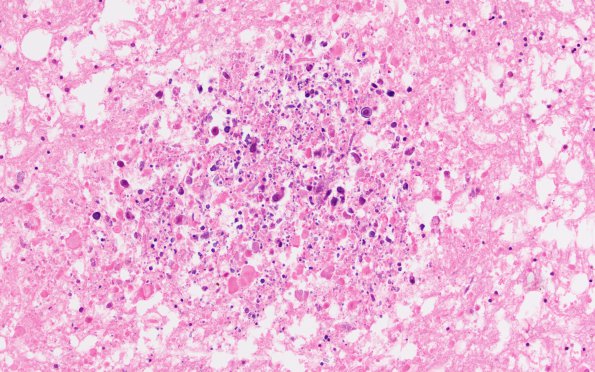 5B3 DNL (Case 5) ALL Rx, MTX local to WM & RAD G H&E 7A