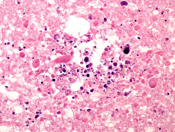 5B4 DNL (Case 5) ALL Rx, MTX local to WM & RAD gross 2