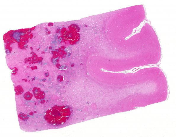 5C1 DNL (Case 5) ALL Rx, MTX local to WM & RAD gross 4