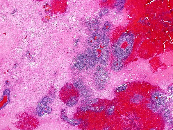 5C2 DNL (Case 5) ALL Rx, MTX local to WM & RAD H&E 5