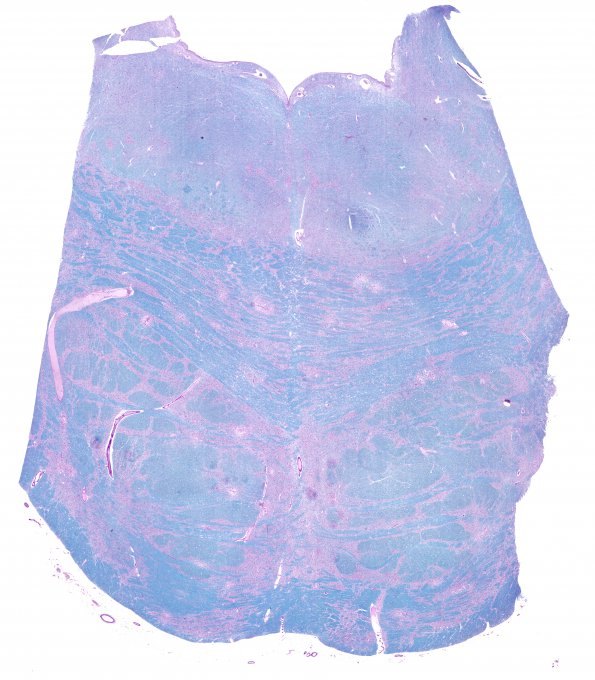 6A2 DNL (Case 6) 1  1 LFB-PAS 1