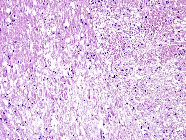 7A3 Necrotizing leukoencephalopathy (Case 7) H&E 6