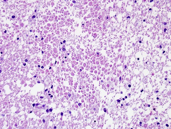 7A5 Necrotizing leukoencephalopathy (Case 7) H&E 2