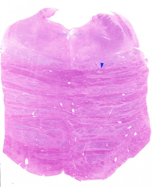 8A1 MTX-Radiation leukoencephalopathy (Case 8) N7 H&E WM copy