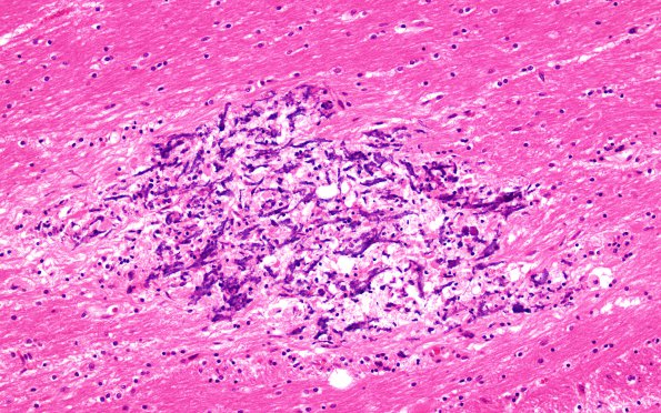 8A3 MTX-Radiation leukoencephalopathy (Case 8) N7 H&E 20X