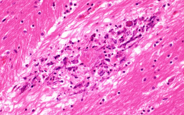 8A4 MTX-Radiation leukoencephalopathy (Case 8) N7 H&E 40X 2