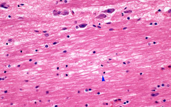 8A5 MTX-Radiation leukoencephalopathy (Case 8) N7 H&E 40X copy