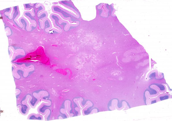 9A1 Necrotizing Leukoencephalopathy (NPExch 2004-Case 2) H&E whole mount