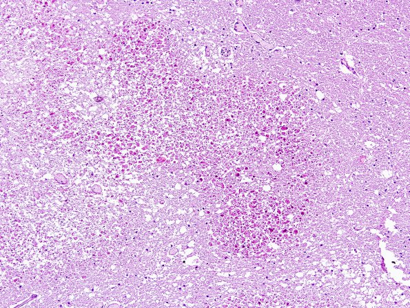 9A2 Necrotizing Leukoencephalopathy (NPExch 2004-Case 2) H&E 6