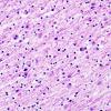 10B2 Neuroaxonal Leukodystrophy POLD (Case 10) H&E 2