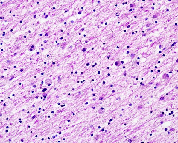 10B2 Neuroaxonal Leukodystrophy POLD (Case 10) H&E 2