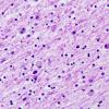 10B3 Neuroaxonal Leukodystrophy POLD (Case 10) H&E 1