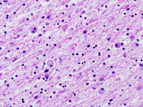 10B3 Neuroaxonal Leukodystrophy POLD (Case 10) H&E 1