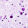 10B4 Neuroaxonal Leukodystrophy POLD (Case 10) Ziehl-Nilsson 2 copy