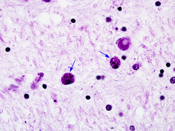 10B4 Neuroaxonal Leukodystrophy POLD (Case 10) Ziehl-Nilsson 2 copy