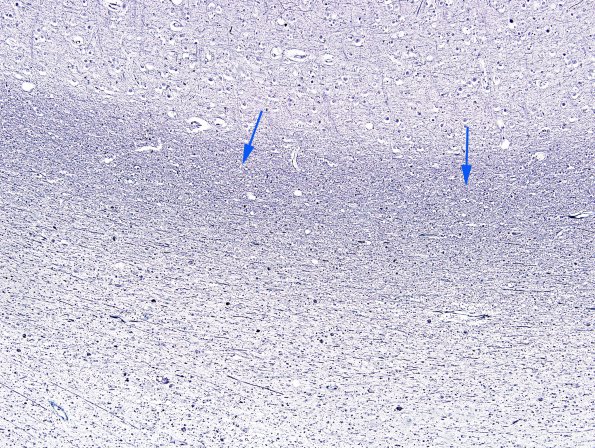 10C2 Neuroaxonal Leukodystrophy POLD (Case 10) Bodian 1 copy