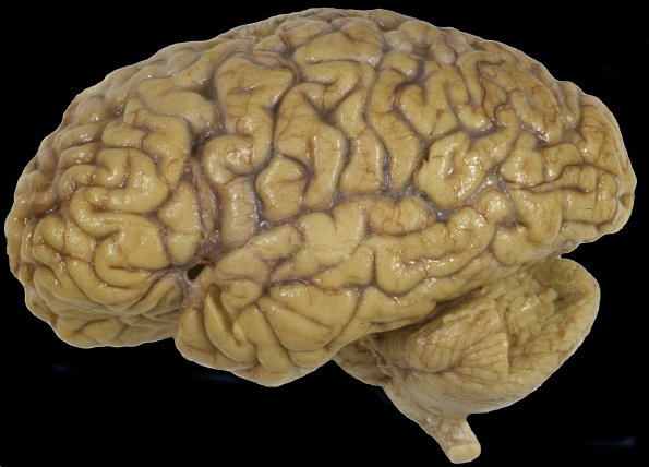 1A1 Neuroaxonal Leukodystrophy (POLD,HDLS, Case 1) 1Adobe