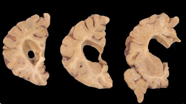 1A2 Neuroaxonal Leukodystrophy (POLD,HDLS, Case 1) 3