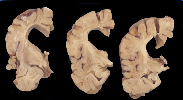 1A3 Neuroaxonal Leukodystrophy (POLD,HDLS, Case 1) 5E