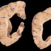 1A4 Neuroaxonal Leukodystrophy (POLD,HDLS, Case 1) 1 copy