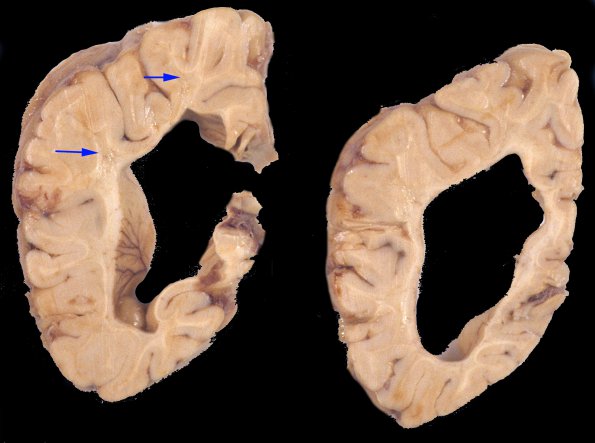 1A4 Neuroaxonal Leukodystrophy (POLD,HDLS, Case 1) 1 copy