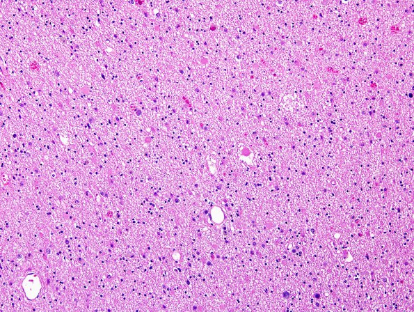 1B3 Neuroaxonal Leukodystrophy (POLD,HDLS, Case 1) R5P H&E 2 (2)