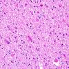 1B4 Neuroaxonal Leukodystrophy (POLD,HDLS, Case 1) R5P H&E 1 copy