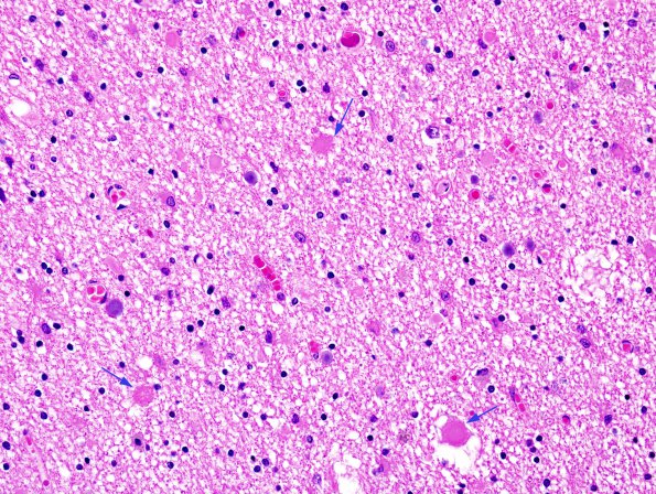 1B4 Neuroaxonal Leukodystrophy (POLD,HDLS, Case 1) R5P H&E 1 copy