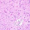 1B5 Neuroaxonal Leukodystrophy (POLD,HDLS, Case 1) L4 1