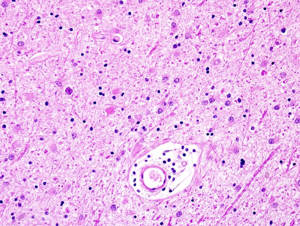 1B5 Neuroaxonal Leukodystrophy (POLD,HDLS, Case 1) L4 1