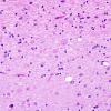 1B6 Neuroaxonal Leukodystrophy (POLD,HDLS, Case 1) L3 H&E 4